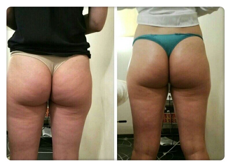 before and after madero therapy